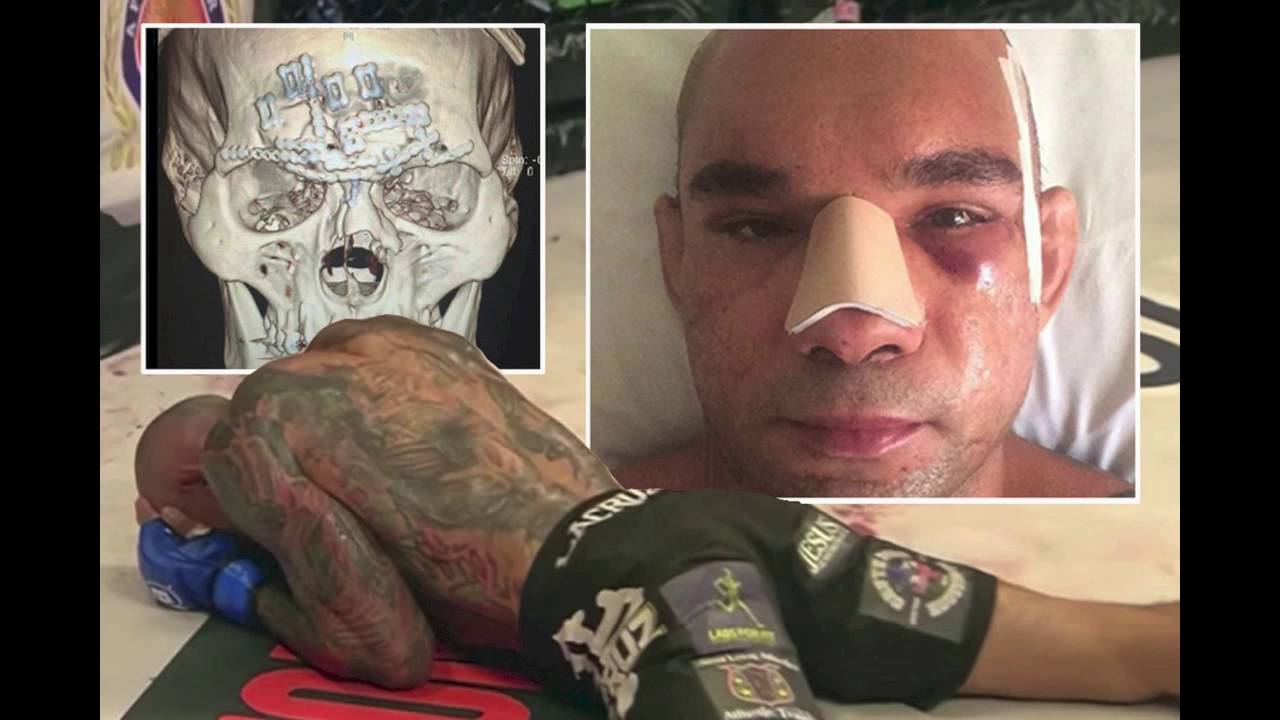 Cyborg Santos broken skull